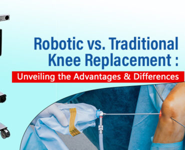 robotic knee replacement